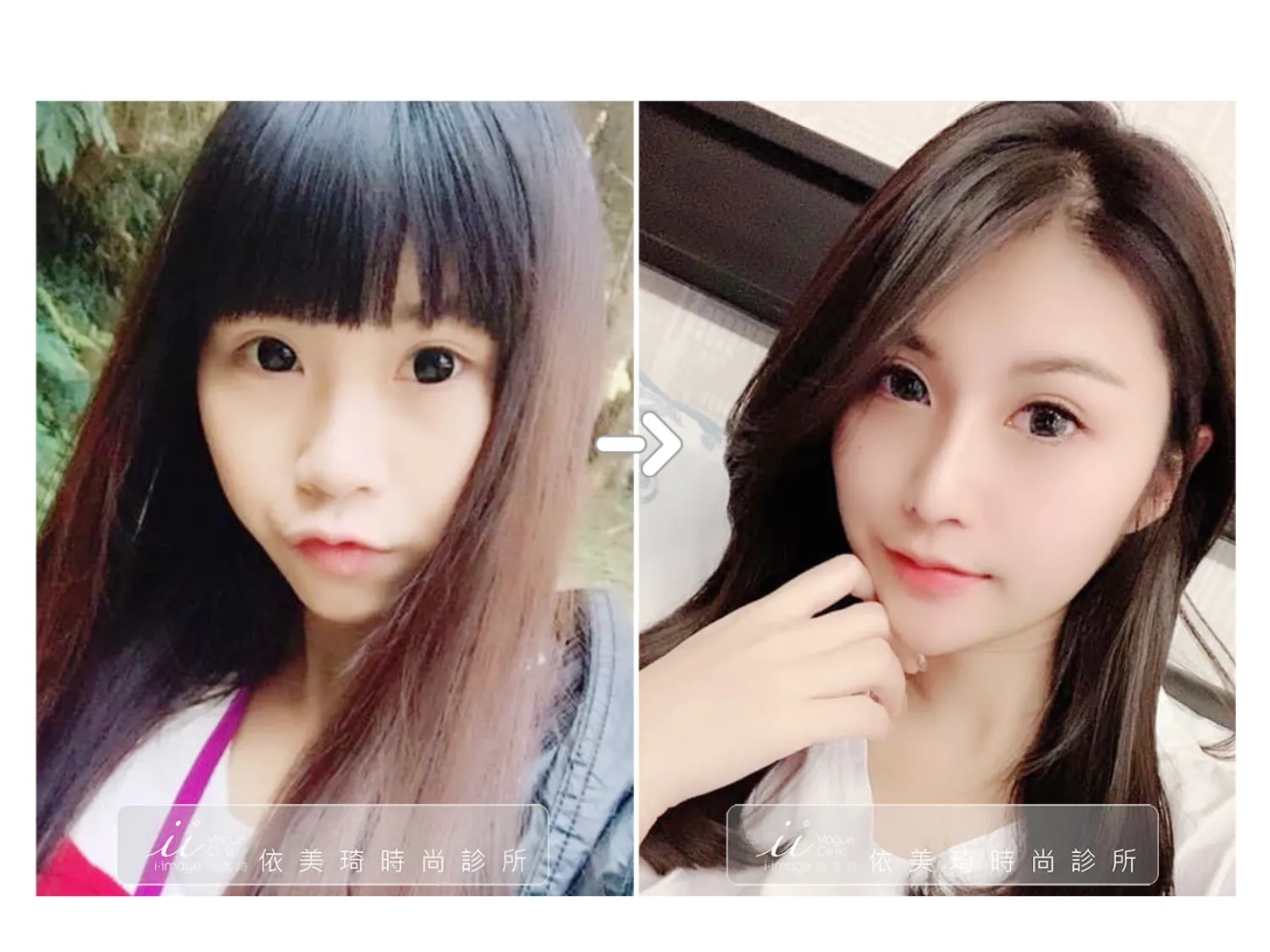 三段結構式隆鼻實際案例