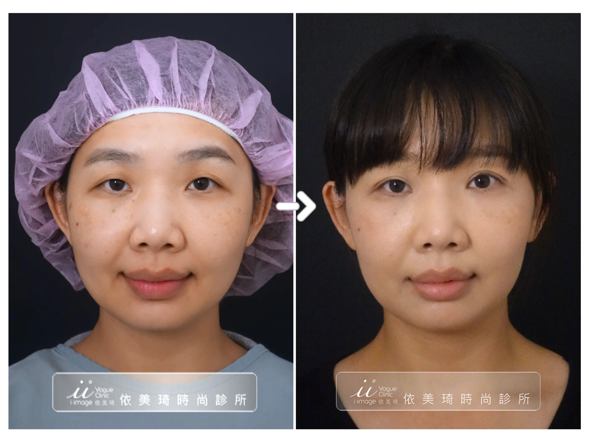QQ隱痕雙眼皮案例分享