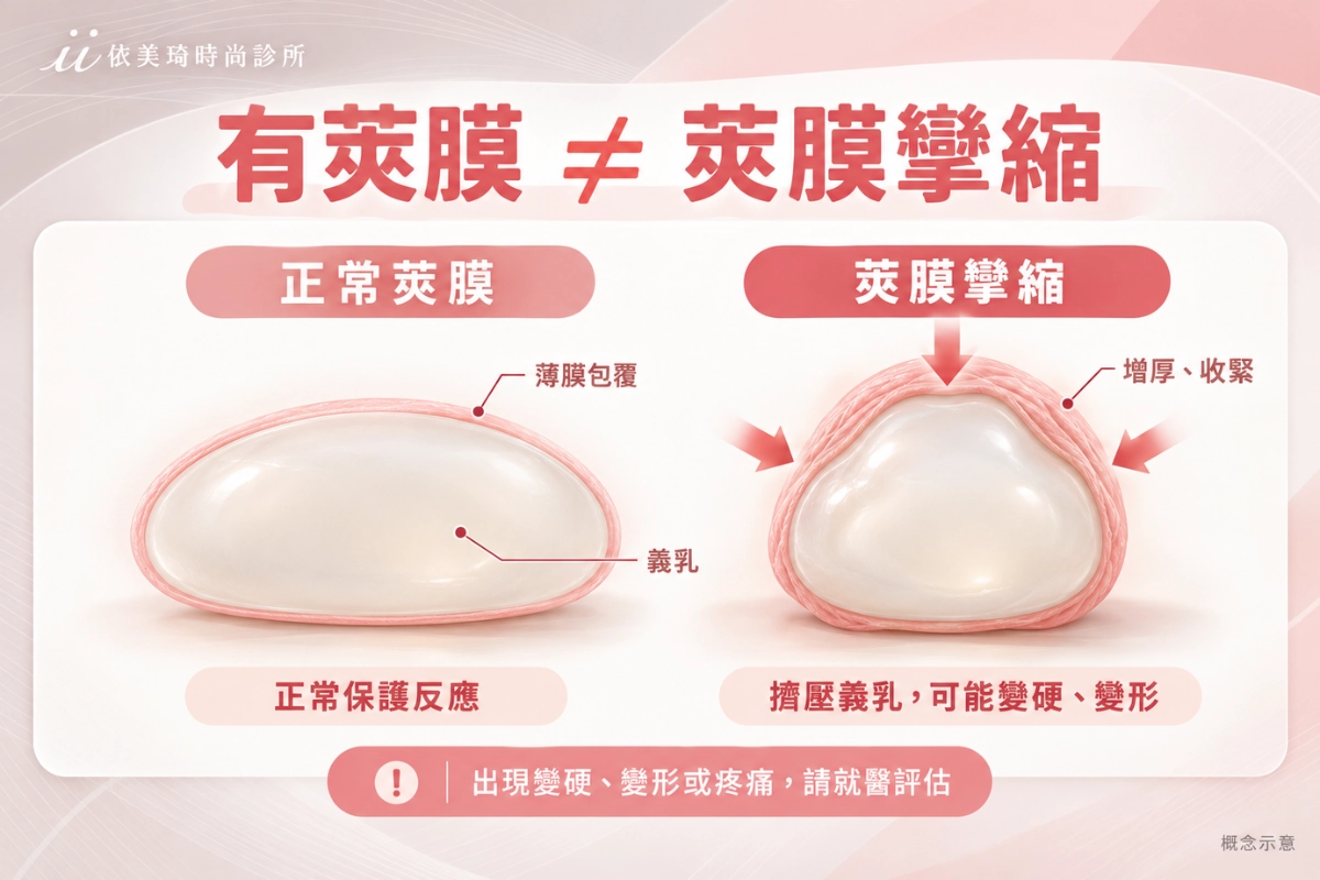 莢膜攣縮：義乳周圍纖維莢膜增厚收縮的示意
