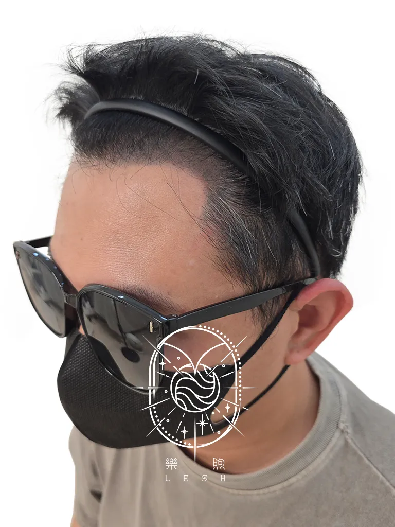 男性髮際線填補 After
